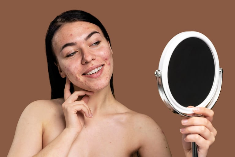 El acné adulto en las mujeres se caracteriza por un acné predominantemente inflamatorio. Freepick