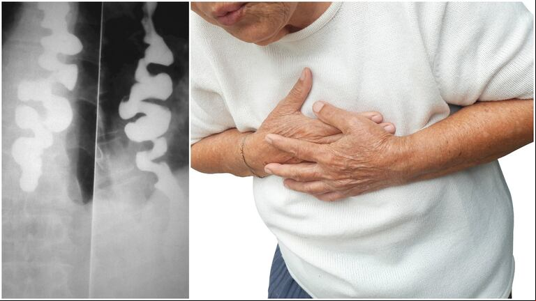 El esófago en tirabuzón se da en casos excepcional es (Foto: Shutterstock/DAMRONG RATTANAPONG).