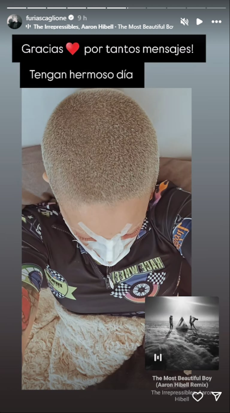Furia Scaglione mostró cómo le quedó la nariz a un día de hacerse una cirugía estética  (Foto: Instagram /furiascaglione)