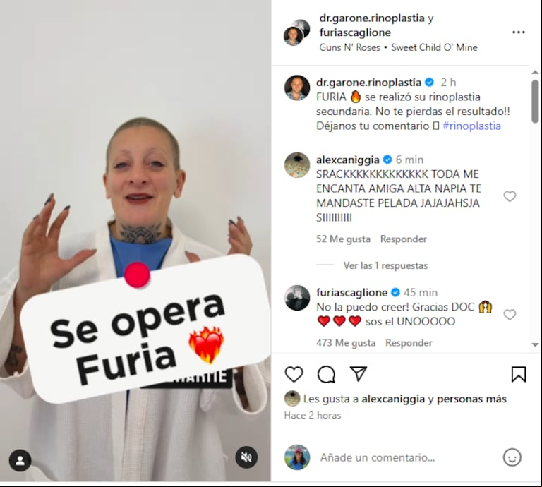 Furia Scaglione se sometió a una rinoplastia y compartió imágenes del antes y después: el video (Foto: Instagram /furiascaglione)