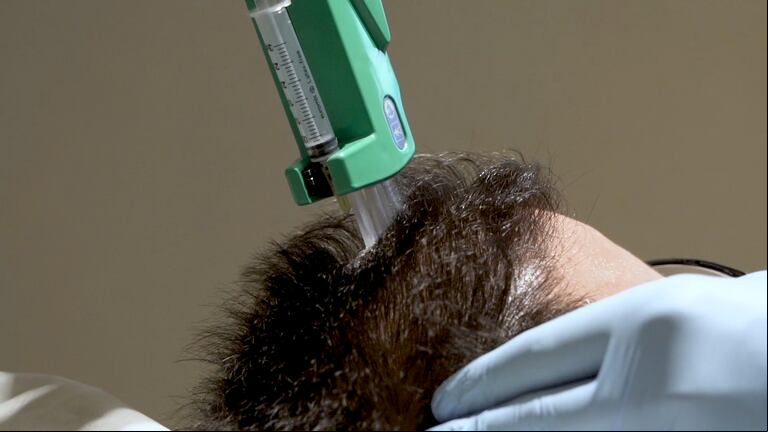Hay métodos quirúrgicos y otros no invasivos. (Foto: Hair Recovery)