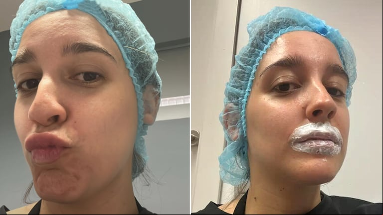 Una joven fue a sacarse ácido hialurónico de los labios a una estética pero terminó de la peor manera