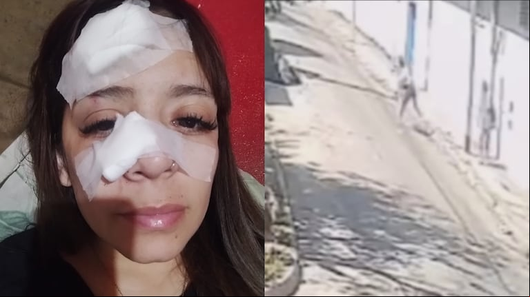 Ataque en Bernal: una mujer se negó a darles comida a dos personas y le fracturaron la nariz con una piedra