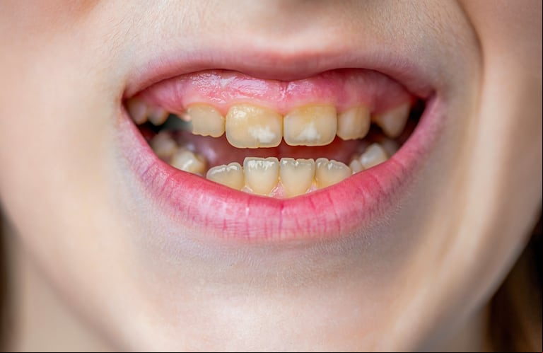 Los dientes de tiza son diez veces más frágiles que los dientes normales. Yevhen - stock.adobe.com