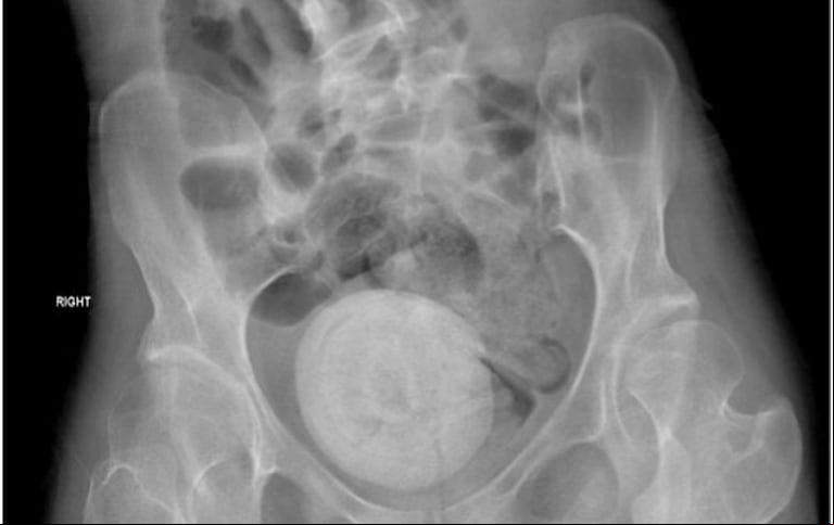 Los médicos utilizaron terapia con láser para disolver la masa. ( Foto Urology Case Reports)
