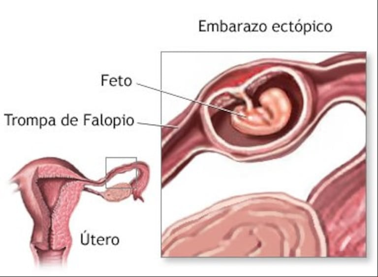 Representación de un embarazo ectópico